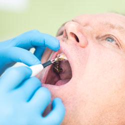 Major Dental Work